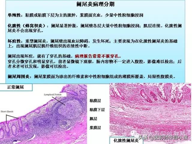 阑尾炎课件,阑尾炎的超声课件