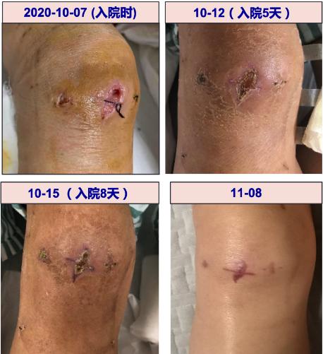 60岁阿姨被缝线针戳破膝盖,引发感染,住院治疗1个月