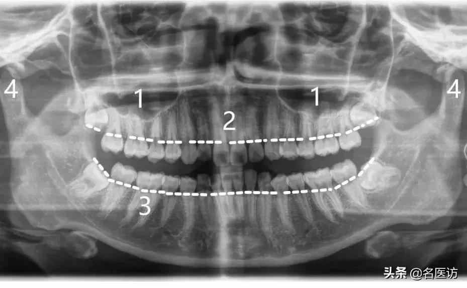 矫正科普|美人在骨不在皮，从神秘的牙片看牙齿和侧貌颜值
