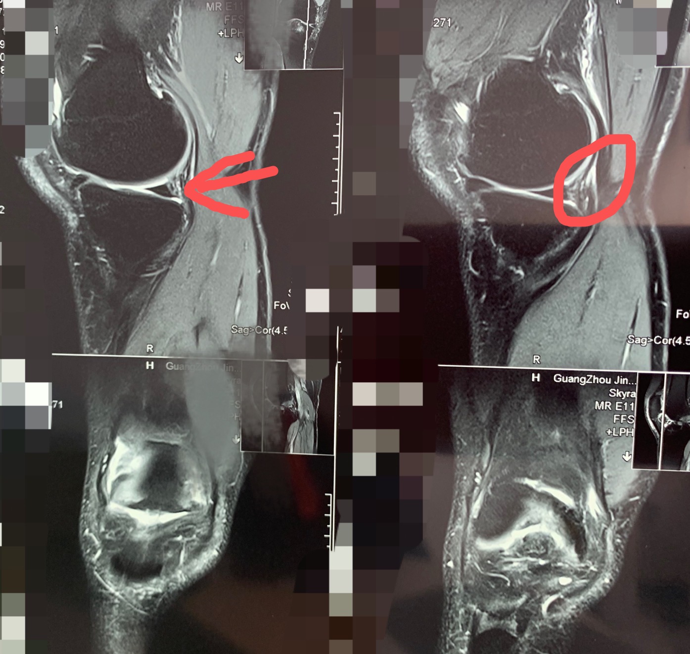 半月板撕裂多长时间能完全恢复nba,半月板受伤有没有完全恢复的可能