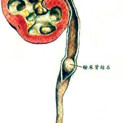 得了结石不要怕医生教你用中药,得了结石不要吃什么