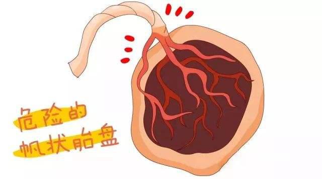 孕期前置血管症状是什么,血管前置的孕妇后期注意什么