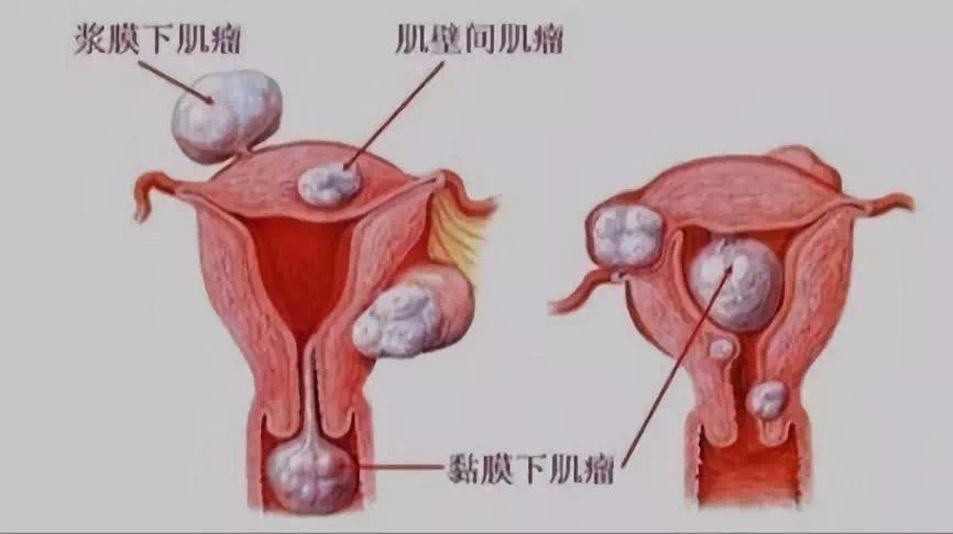 子宫肌瘤的十问十答科普,子宫肌瘤的10个常识