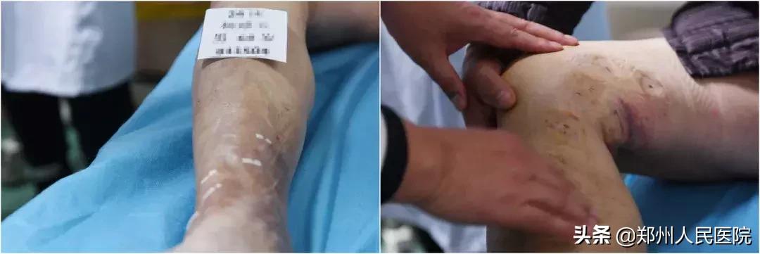 蚯蚓腿需要治疗吗,蚯蚓腿不开刀治疗