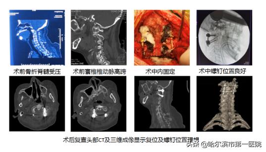 一家人与名医的“不解之缘”——哈尔滨市第一医院完成高难度复杂枢椎齿状突骨折内固定术