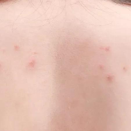 又到了穿小裙的季节，鸡皮女孩该怎么办……