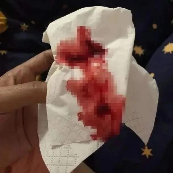 病人突然大咯血需要介入吗,医生抢救肺栓塞视频