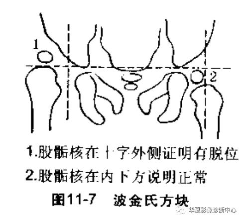 先天性髋关节脱位,先天性髋关节脱位属不属于残疾人