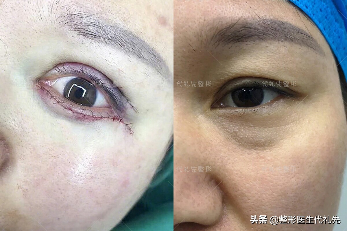 不开刀祛眼袋和开刀祛眼袋哪个好,问一下有什么方法快速消除眼袋