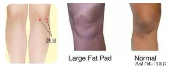 膝盖疼应该知道的几件事,膝眼痛考虑何病