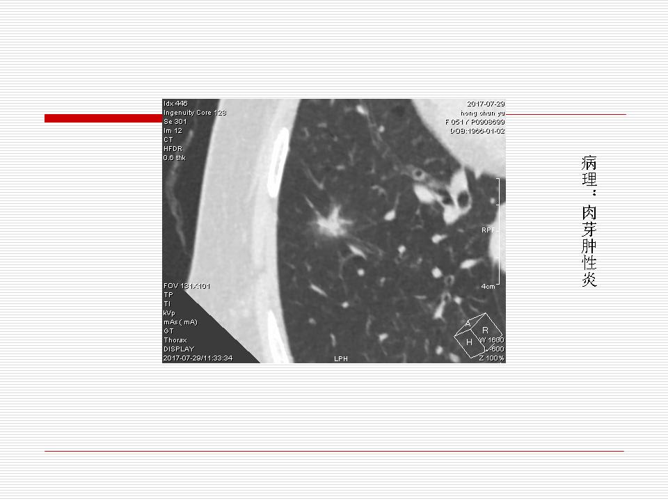 像炎症的肺癌能治好吗,医生说可能是肺癌也可能是炎症