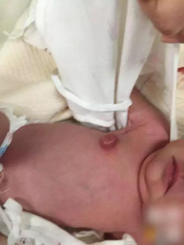 新生儿需要挤乳头？答：千万别，这会影响以后的发育