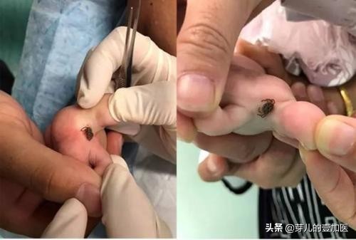 有蜱虫咬的人怎么处理,为什么有人被蜱虫咬也没事