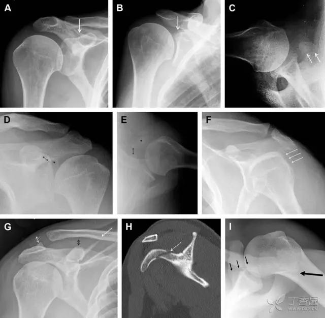 放射科夜班病例大全,放射科容易漏诊的骨折