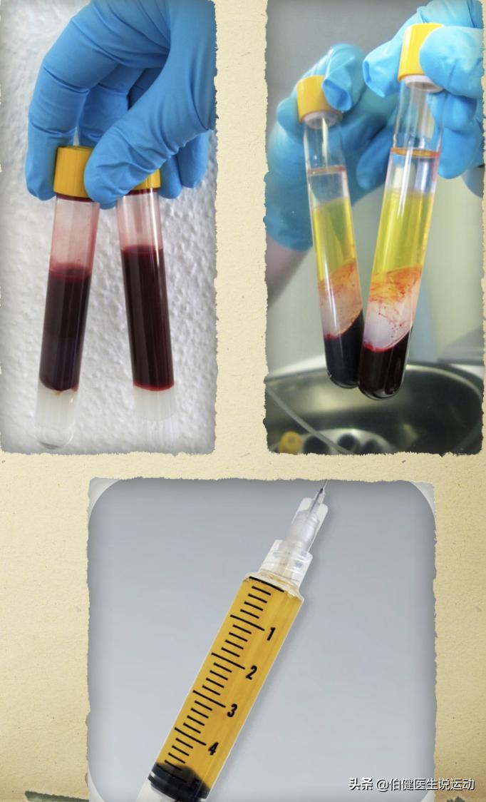 髌骨软化症有没有办法消除炎症,髌骨软化髌骨关节炎怎么治疗