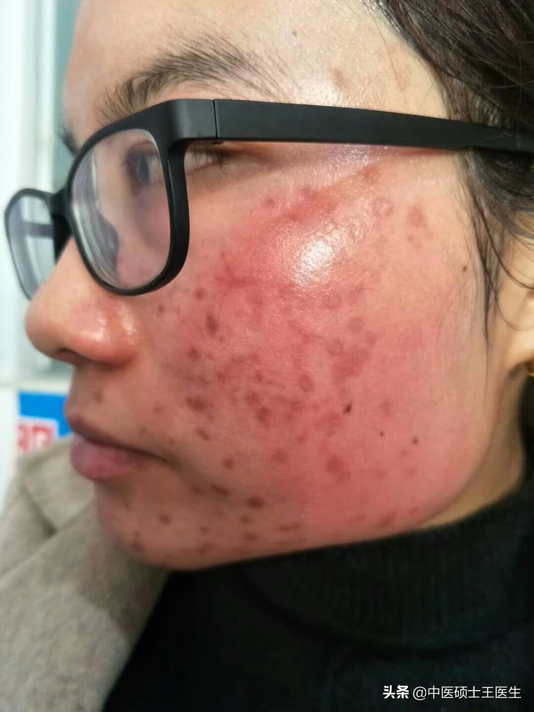 中医祛痘多少钱,中医祛痘挂什么科