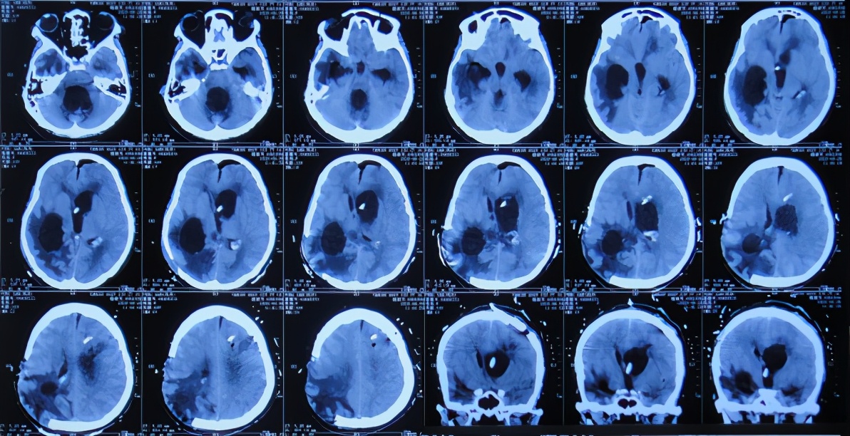 脑室有粘连脑积水有什么办法,脑动脉畸形手术后出现急性脑积水