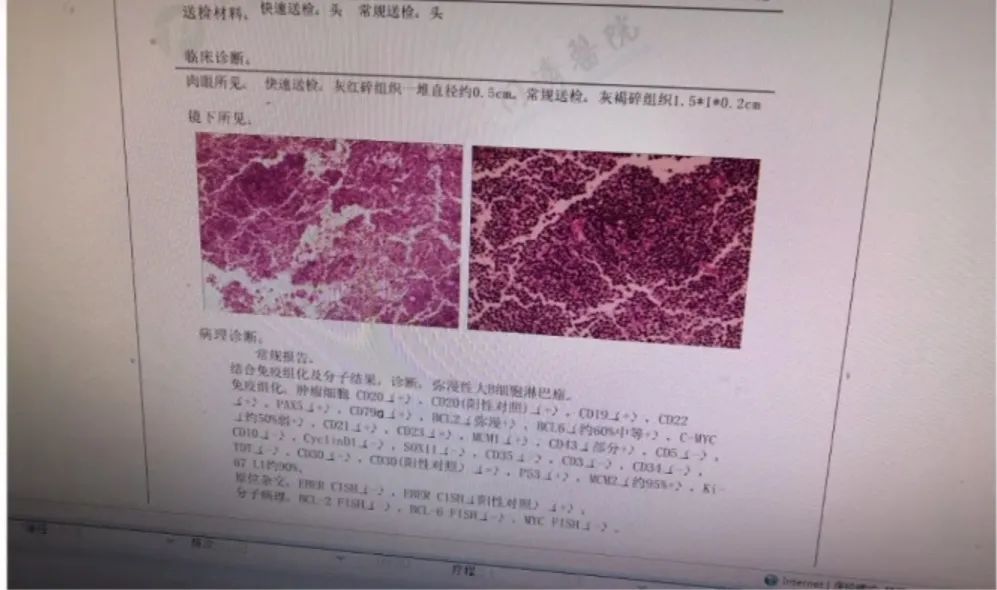 确诊淋巴瘤的最可靠依据是什么,我的淋巴瘤是遗传的能治好吗