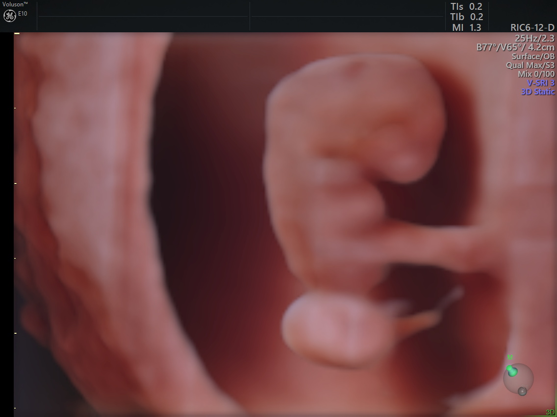 孕期超声,孕期超声一定要做吗