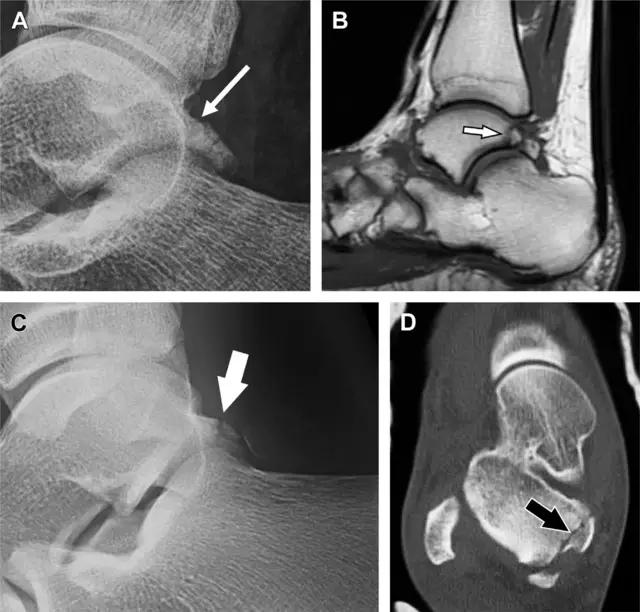 放射科夜班病例大全,放射科容易漏诊的骨折