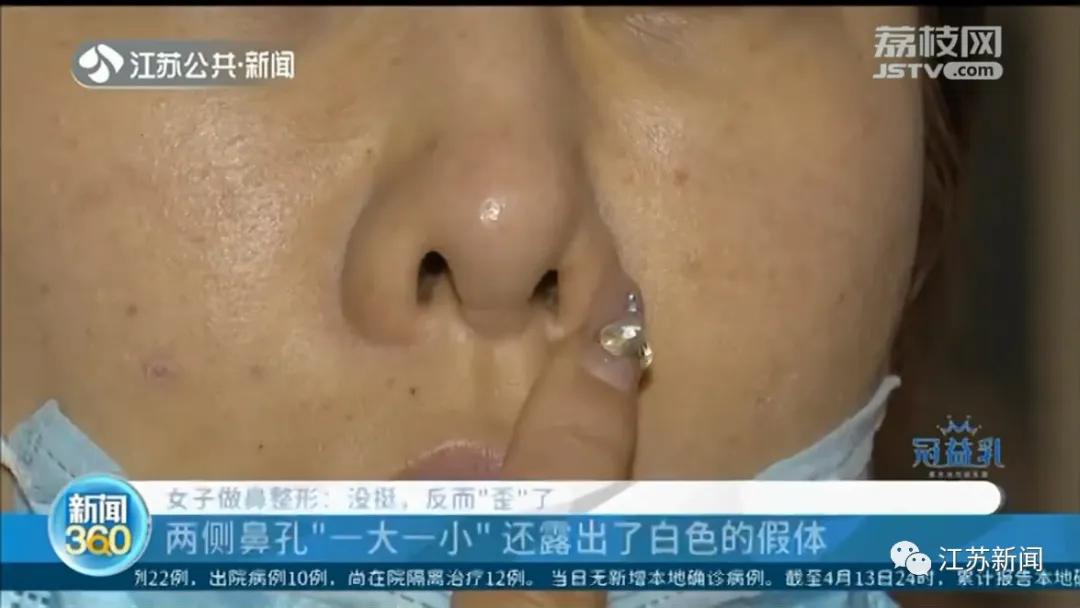 整容鼻子歪了真实案例,女子整容嘴变歪后来怎么样了