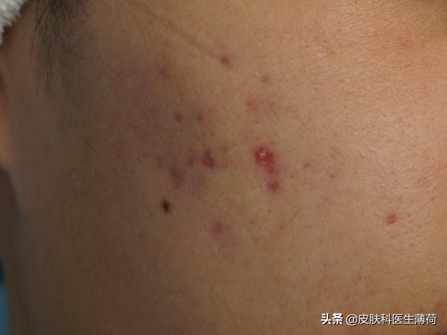 皮肤科医生推荐的去痘印的药,皮肤痘印怎么做才能彻底修复