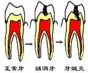 为什么牙疼起来真要命,牙疼不是病疼起来真要命