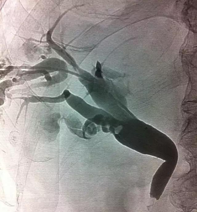 胆囊炎和胆管炎会出现黄疸嘛,化脓性胆管炎会出现黄疸吗