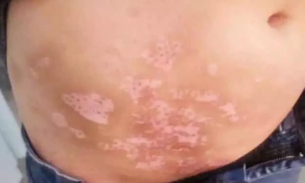 不看不知道，原来你患的是神经节段型白癜风