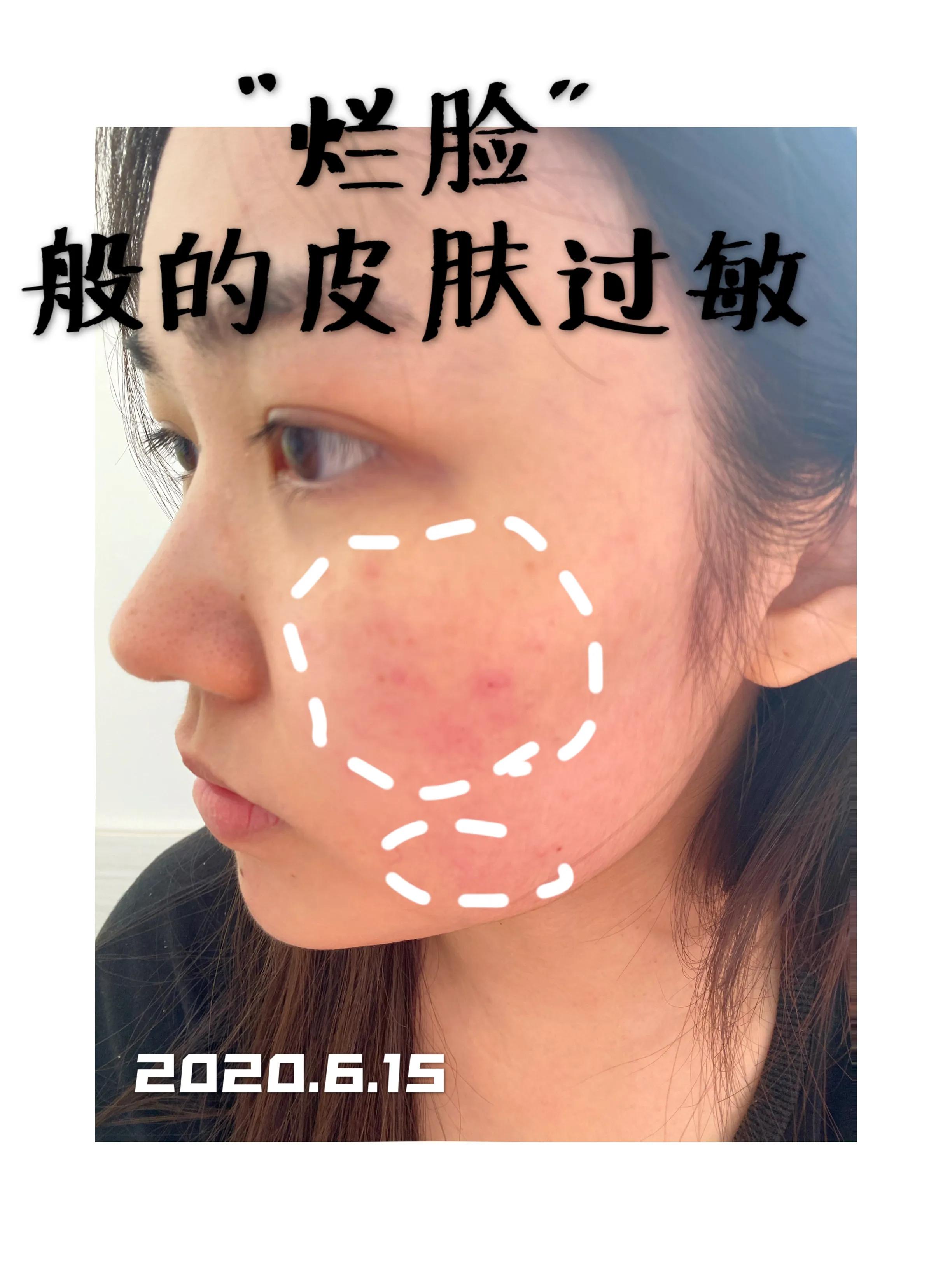 视黄醇过敏烂脸怎么治,烂脸过敏救星