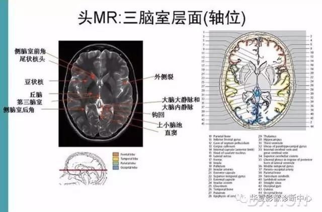 电子版头颅ct与mri断层解剖,头颅mri血管解剖与分段详解