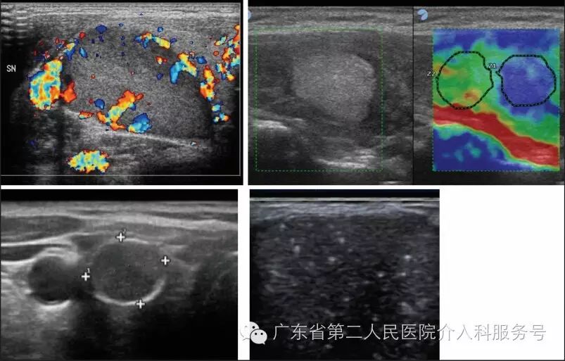 发现有甲状腺结节怎么办？…………权威临床指南为您解答