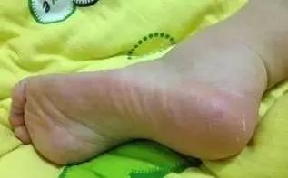 澳洲顶级护脚膏,凡士林手足防裂膏妈妈用