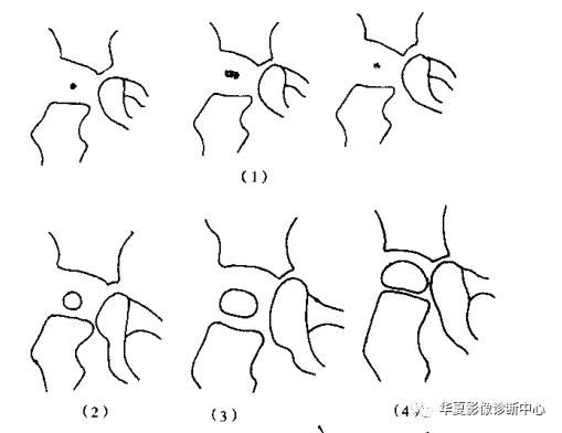 先天性髋关节脱位饮食,先天性髋关节脱位属不属于残疾人