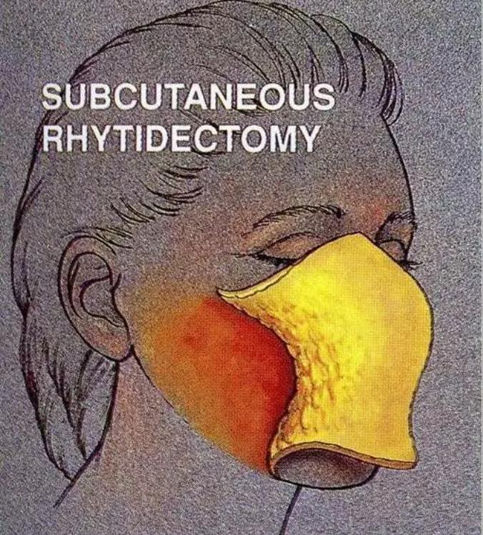 面部除皱手术原理都有哪些呢,面部除皱术发展史