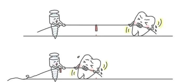 支抗钉和骨钉的区别,13岁矫正牙齿打骨钉亲身经历