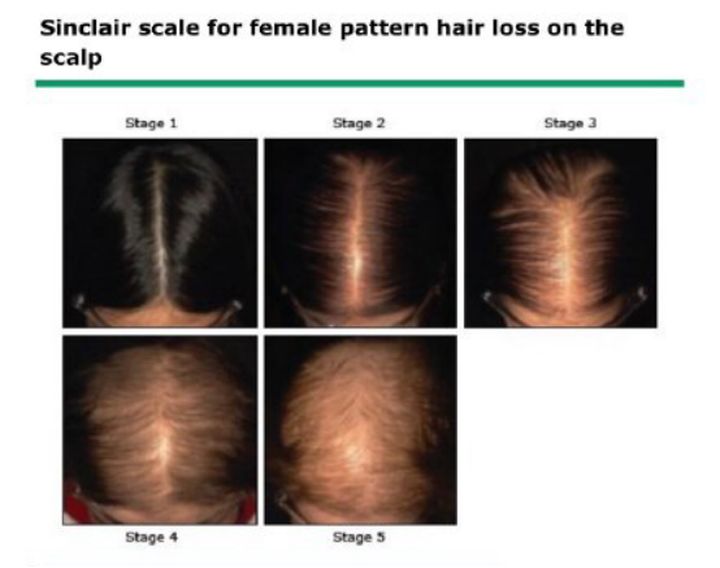 怎样辨别自己脱发,脱发判断最简单的方法