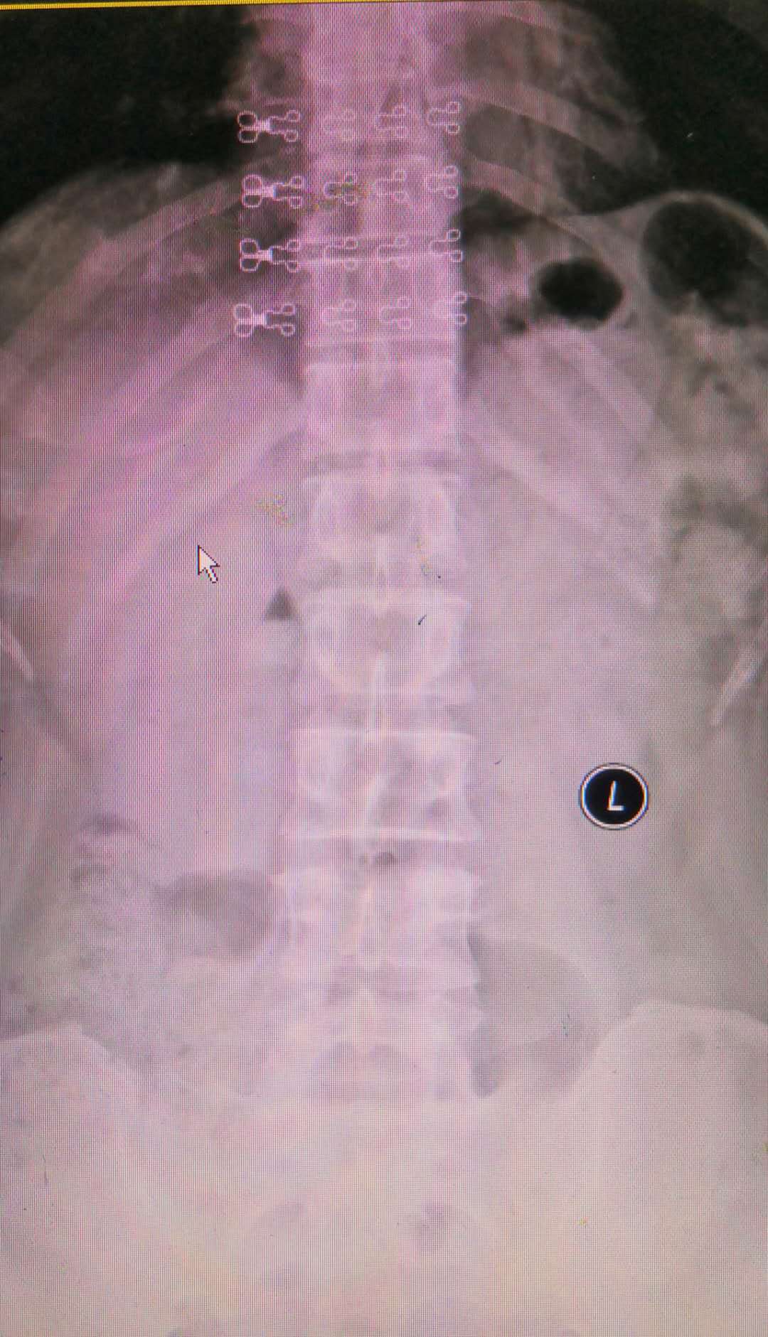 腰椎滑脱做开放手术需要多少费用,腰椎滑脱微创和开放手术哪个好