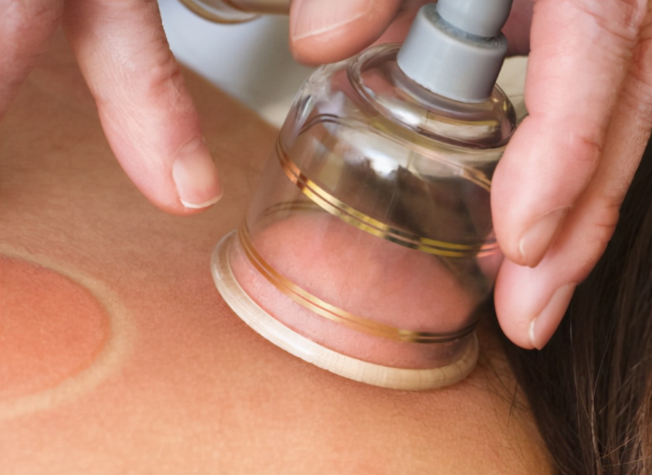 拔火罐后背会痛嘛,拔火罐后背出血泡