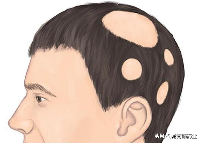 生姜水洗发真的会改善脱发吗,脱发生姜大蒜水能生发吗