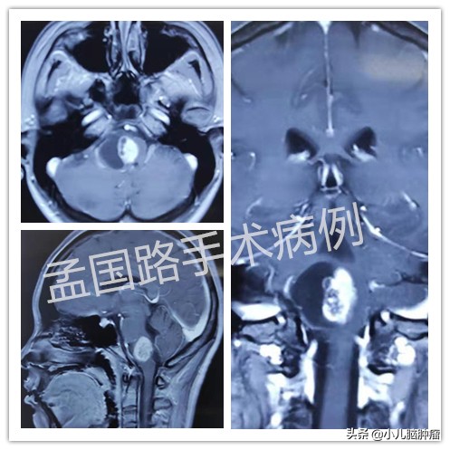 脑干胶质瘤3cm能不能做手术,儿童弥漫性脑干胶质瘤无能为力
