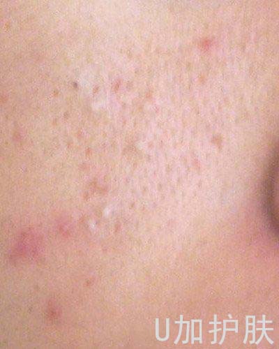 脸上的油脂粒如何去除,怎样有效去除脸上的油脂粒