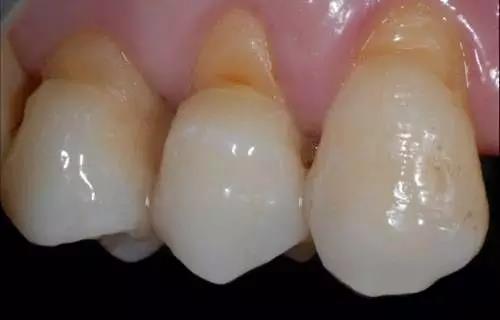 楔状缺损坑,较深的楔状缺损