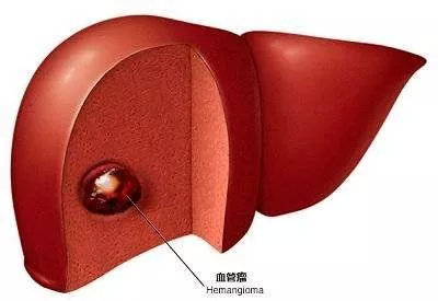 肝脏检查报告的7种异常信号,肝脏检查指标正常还是肝癌
