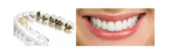 牙齿矫正有几种方式,牙齿矫正刷牙方式视频