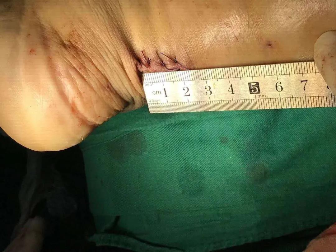 跟腱断裂康复的几个阶段,跟腱断裂手术三周跟腱恢复情况