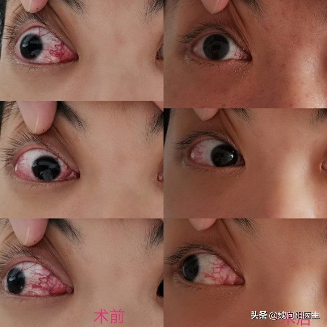 颈动脉海绵窦瘘症状,颈动脉海绵窦瘘介入需要多少钱