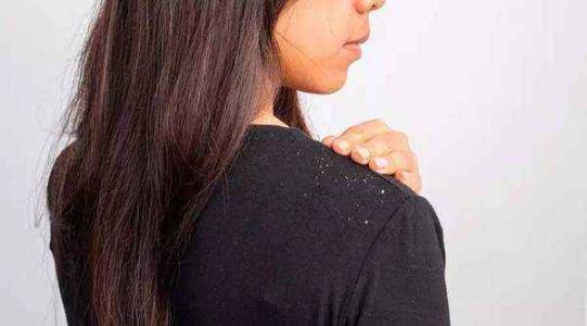 头皮屑最简单的解决方法,头皮屑的原因及解决方法