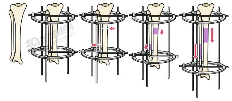做断骨增高的人怎么样了,做了断骨增高看得出来吗