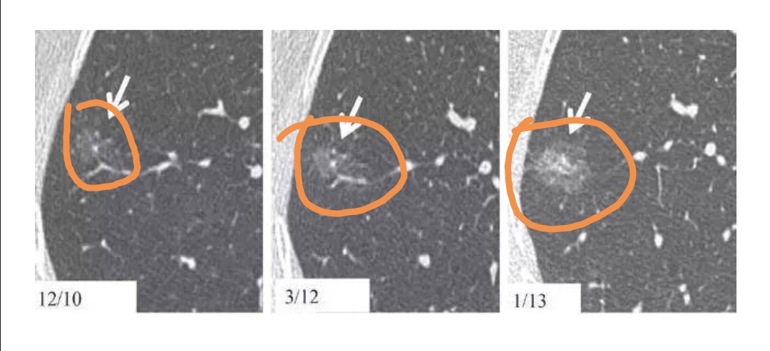 肺小结节4mm半年会不会发展成肺癌,两肺多发小结节是肺癌的前兆吗
